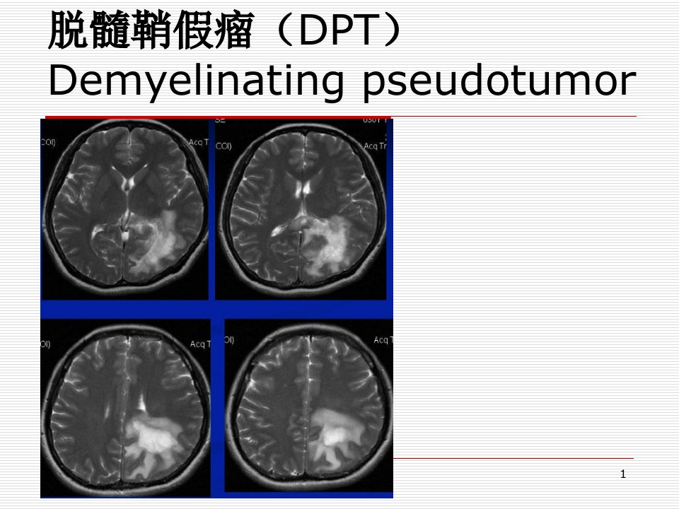 脱髓鞘假瘤MRI诊断医学ppt课件