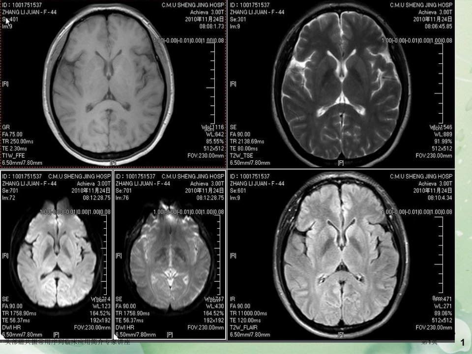 头部磁共振常用序列临床应用简介课件PPT