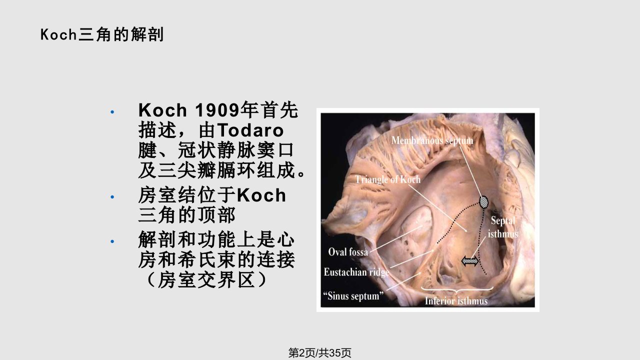 Koch三角解剖与临床