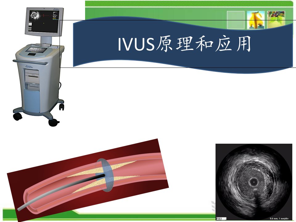 IVUS原理和应用