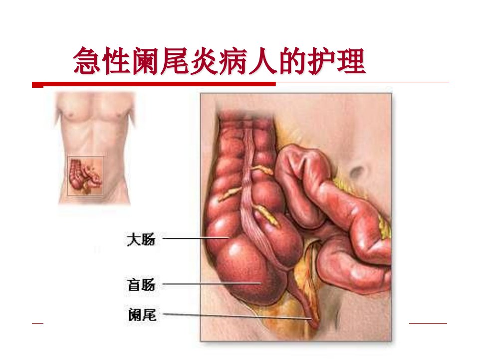 急性阑尾炎病人护理课件