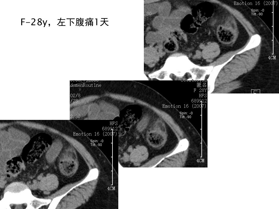 腹腔炎性脂肪性肿块的鉴别诊断