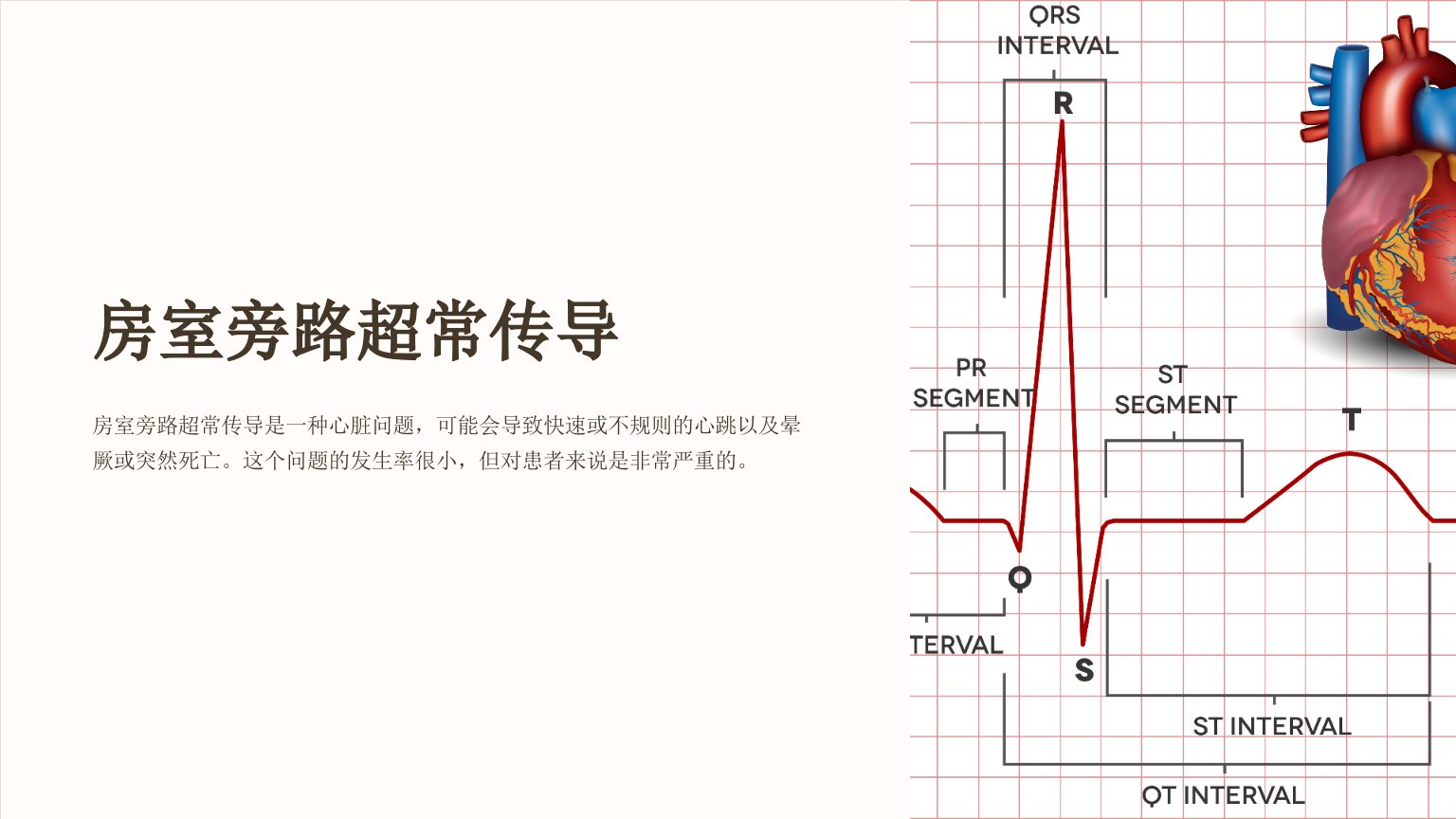 《房室旁路超常传导》课件