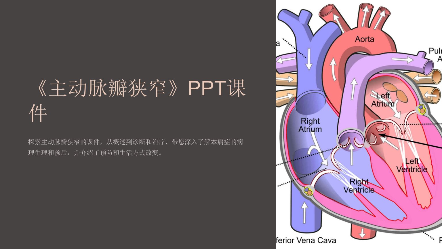 《主动脉瓣狭窄》课件