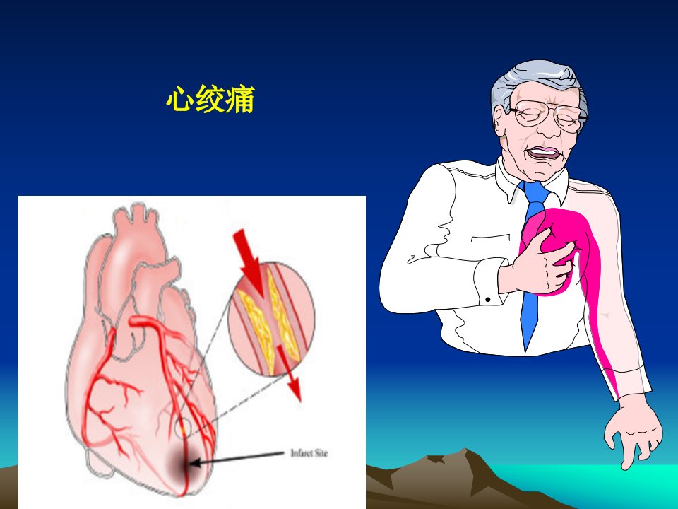 抗心绞痛