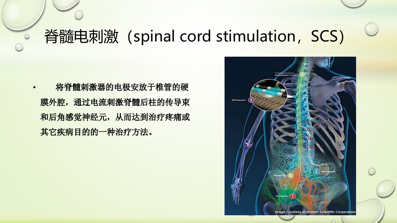 脊髓电刺激治疗研究进展