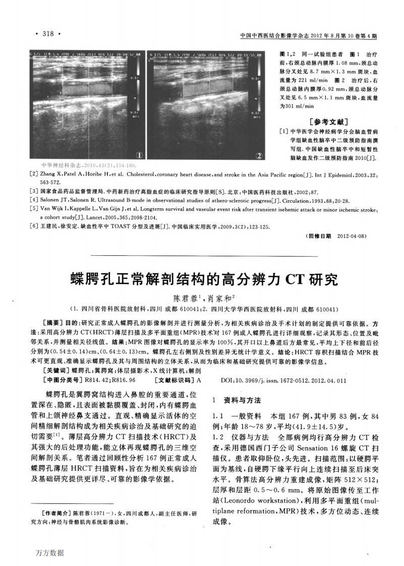 蝶腭孔正常解剖结构的高分辨力ct研究