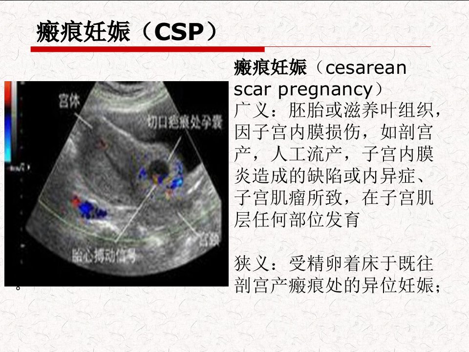 医学专题子宫瘢痕妊娠