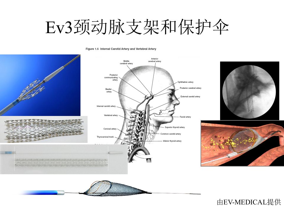 Ev3颈动脉支架和保护伞