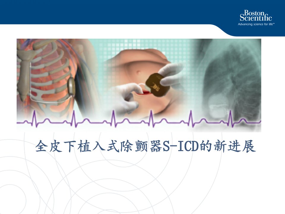 全皮下植入式除颤器SICD的新进展