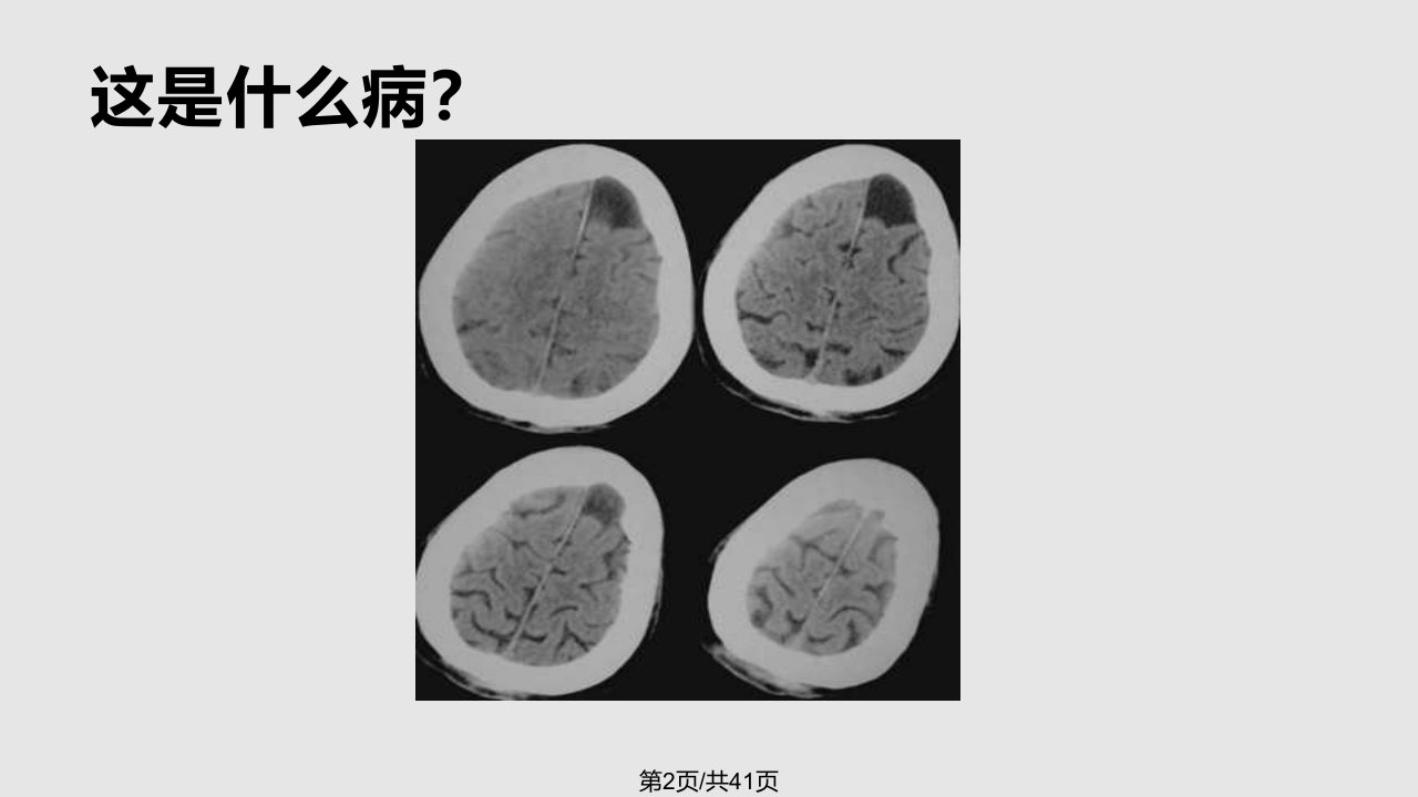 蛛网膜囊肿学习