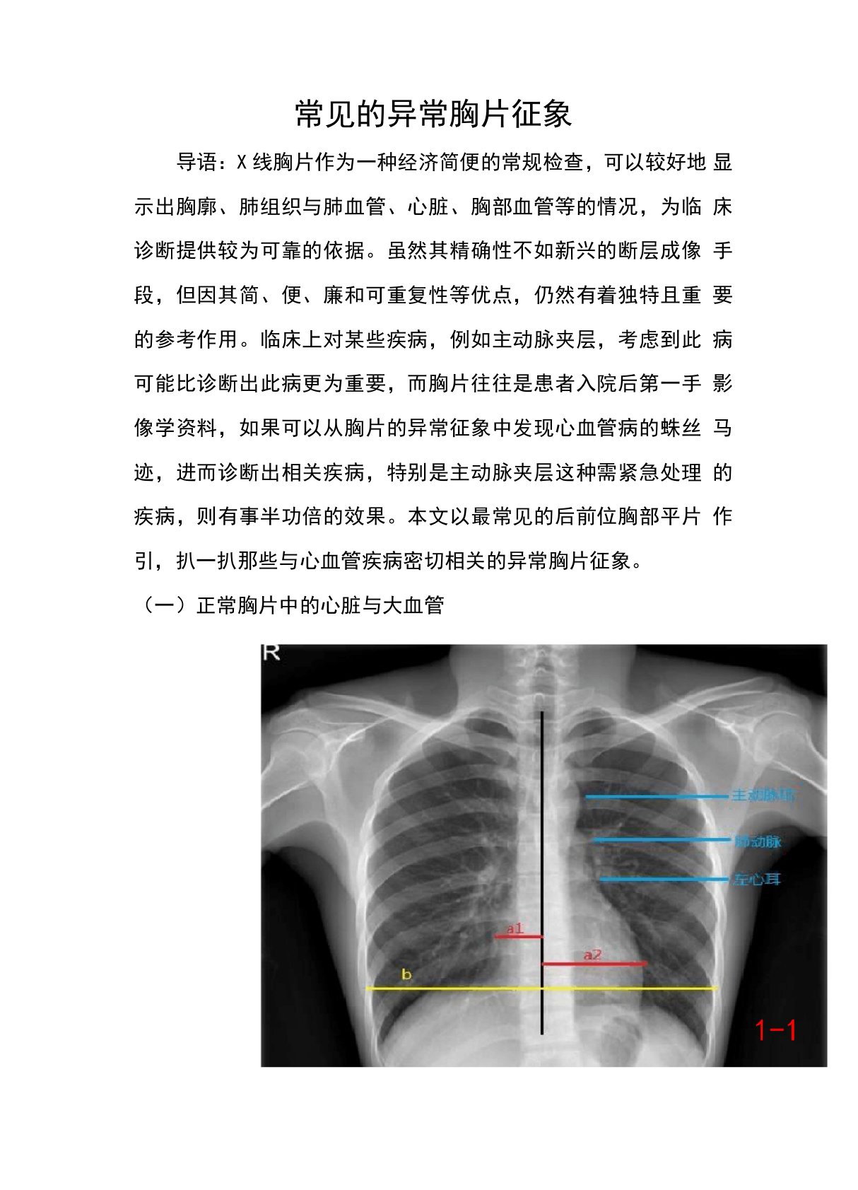 常见的X线胸片