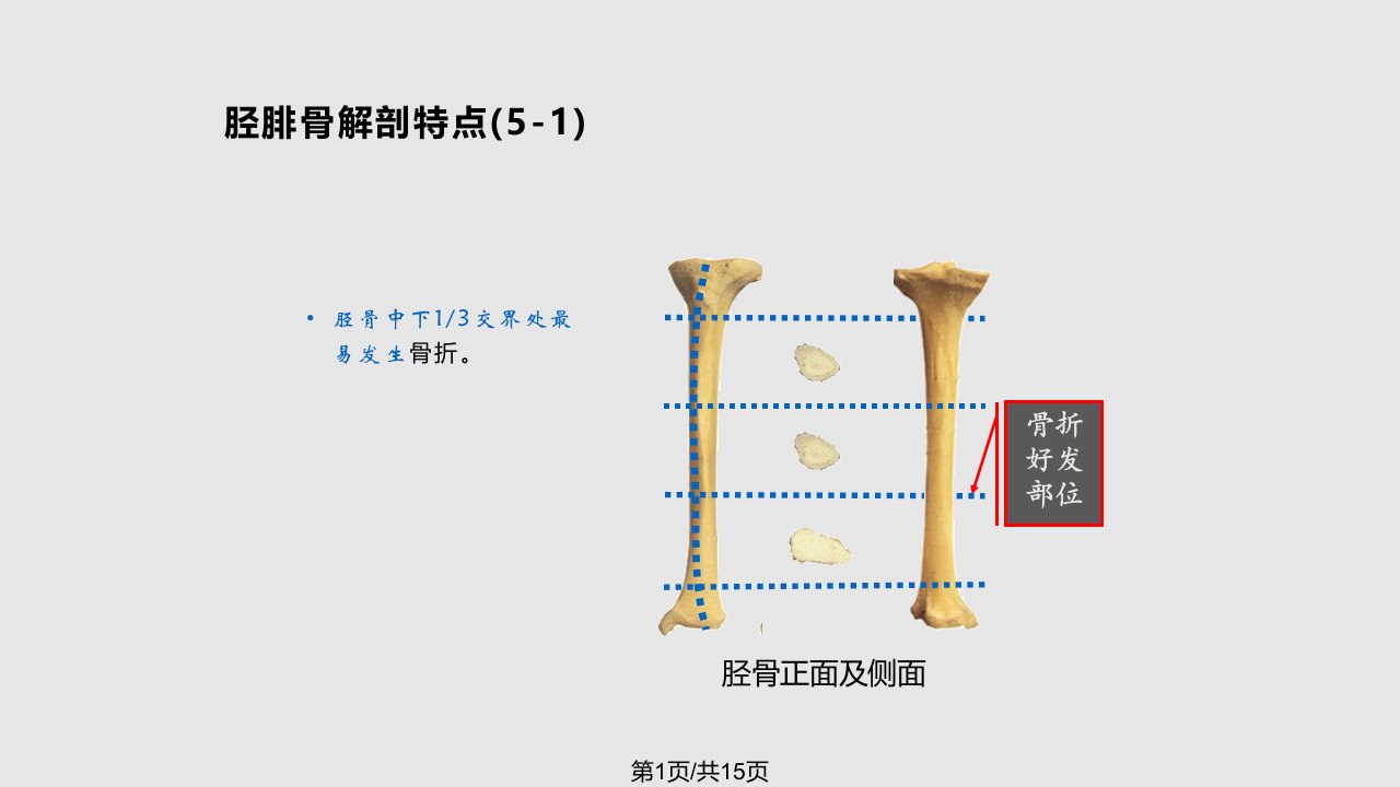 胫腓骨干骨折PPT课件