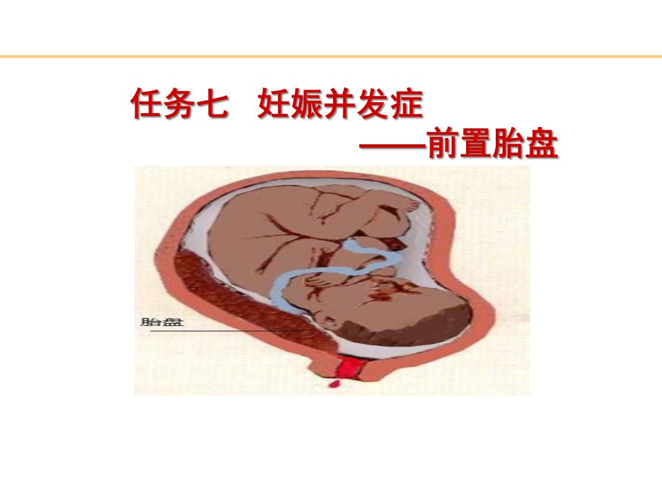 医学专题妊娠并发症之前置胎盘