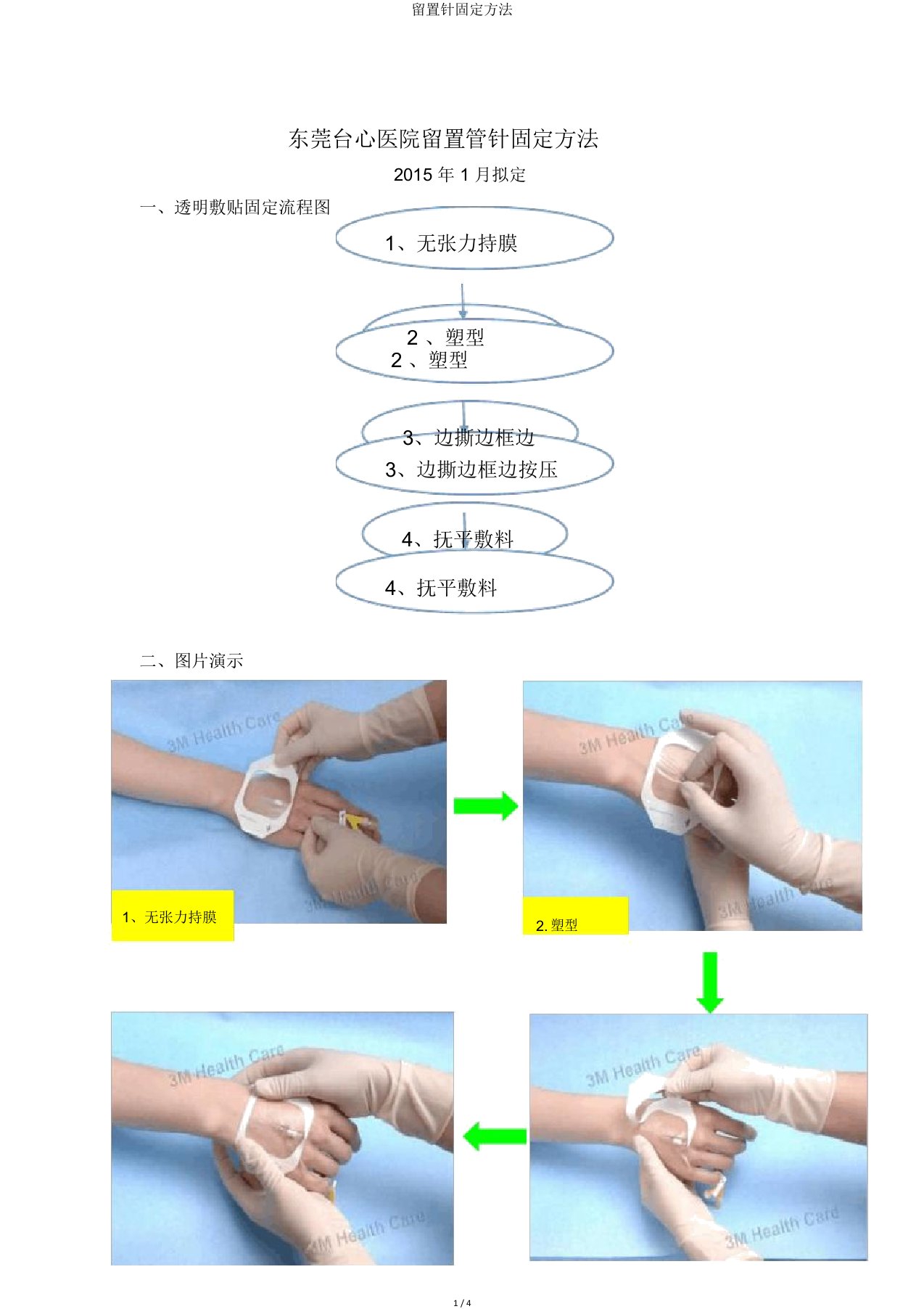 留置针固定方法