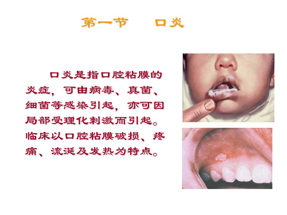 口炎患儿的护理PPT课件