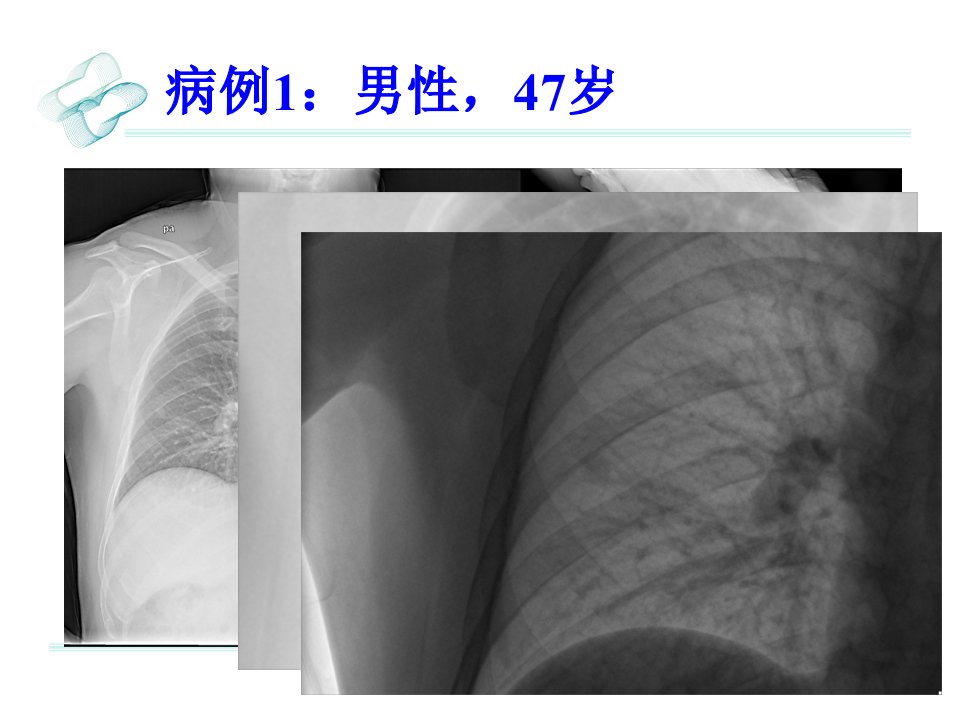 肺硬化性血管瘤影像学诊断