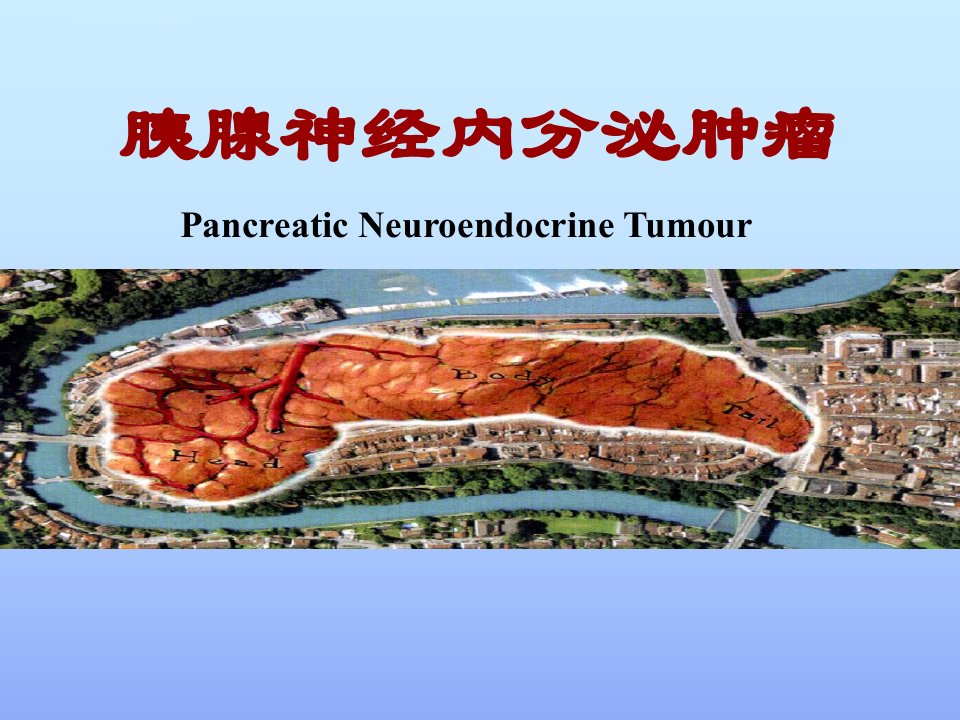 胰腺神经内分泌肿瘤ppt课件