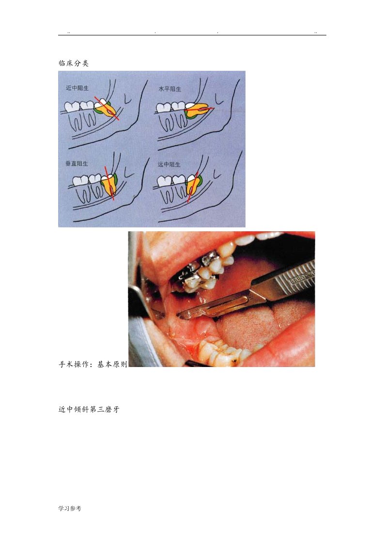 阻生第三磨牙拔除