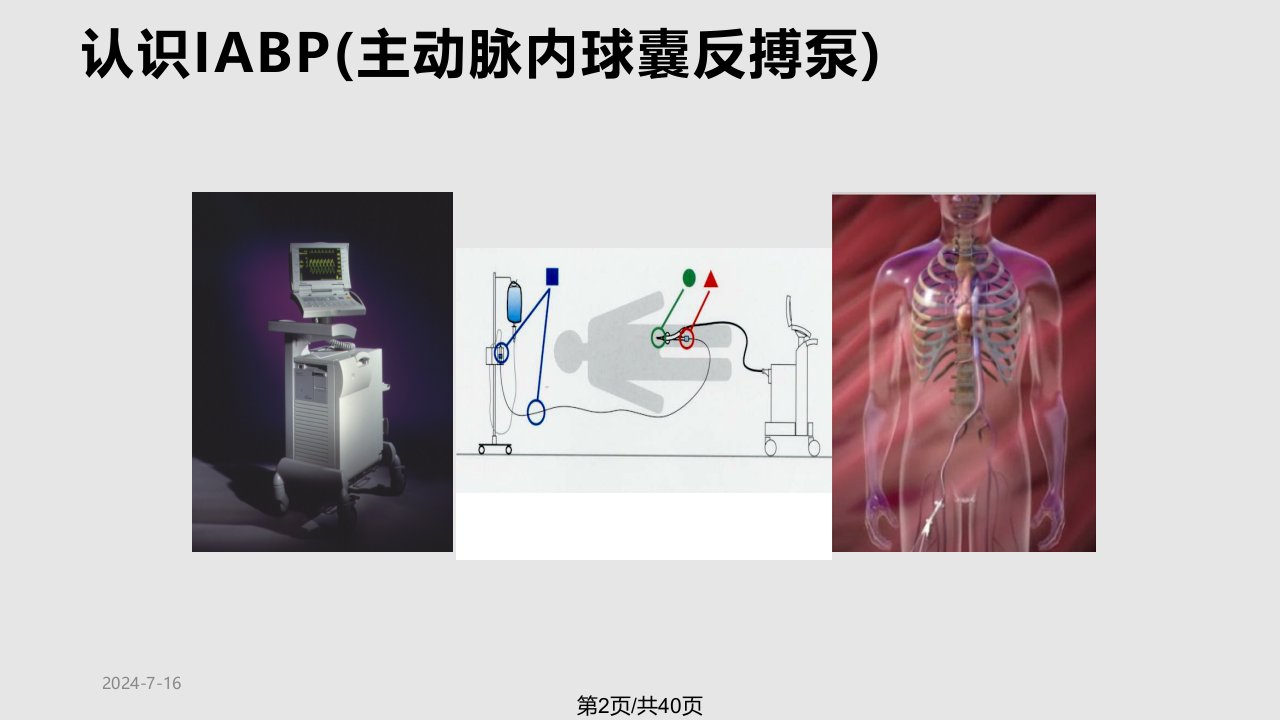 IABP主动脉球囊反搏