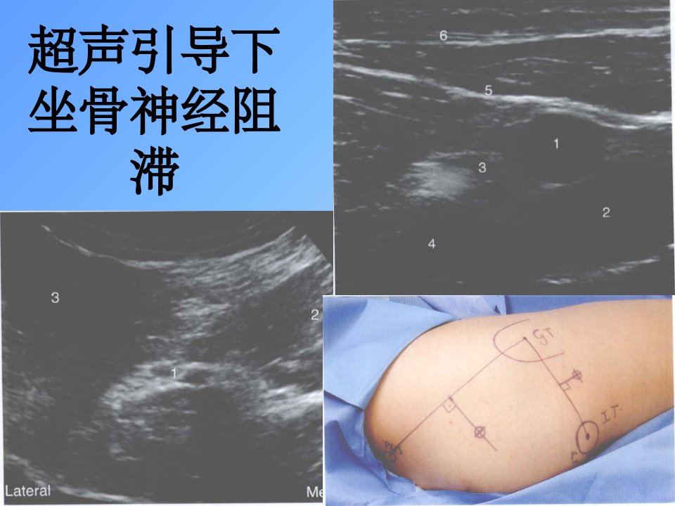 坐骨神经阻滞