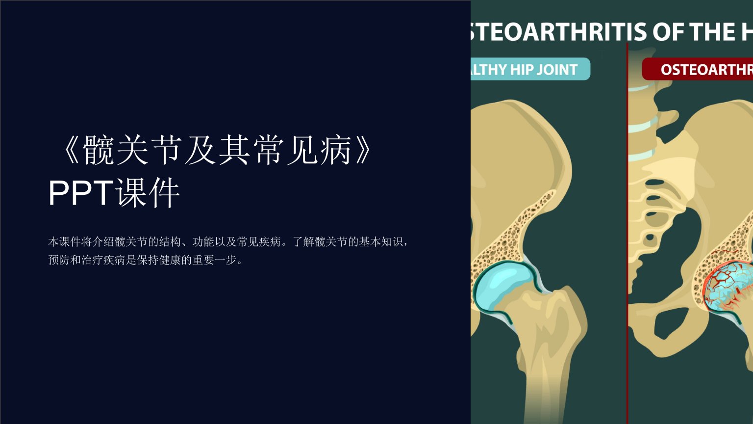 《髋关节及其常见病》课件