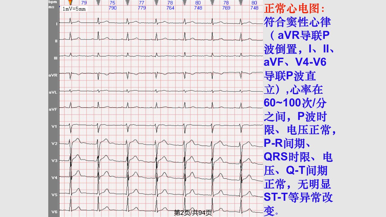 常见心电图诊断实习生之二课件