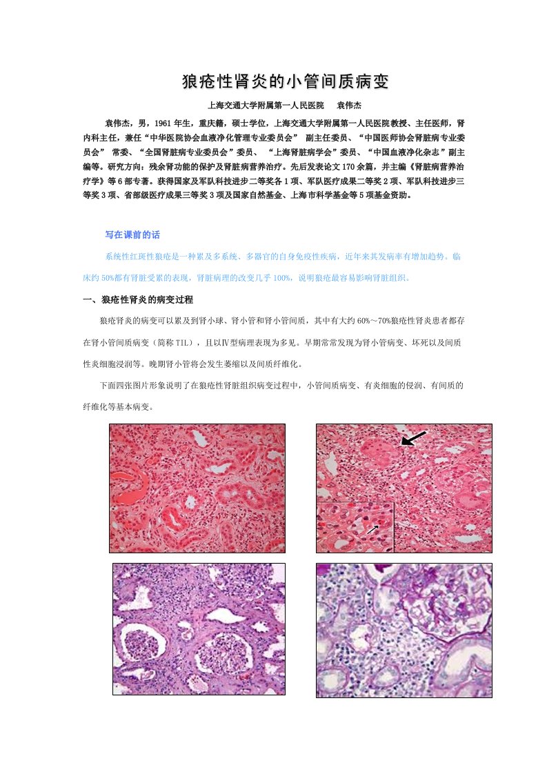 狼疮性肾炎的小管间质病变(袁伟杰)