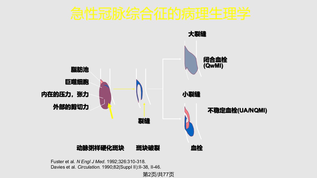 ACS急性冠脉综合