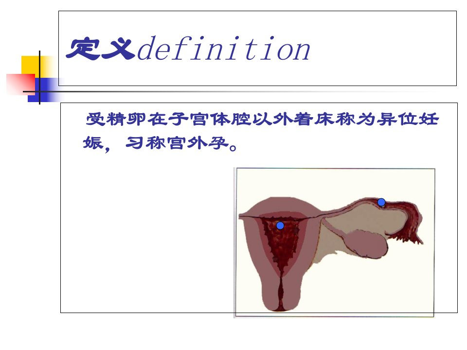 最新异位妊娠西医PPT课件