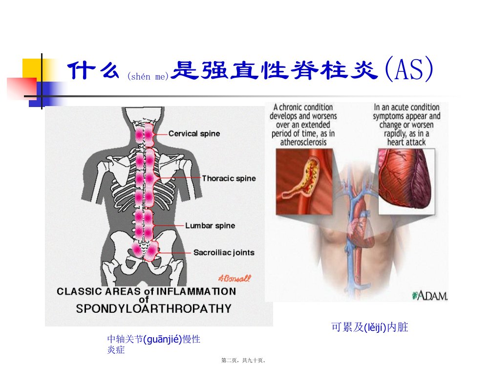 医学专题强直性脊柱炎驼背