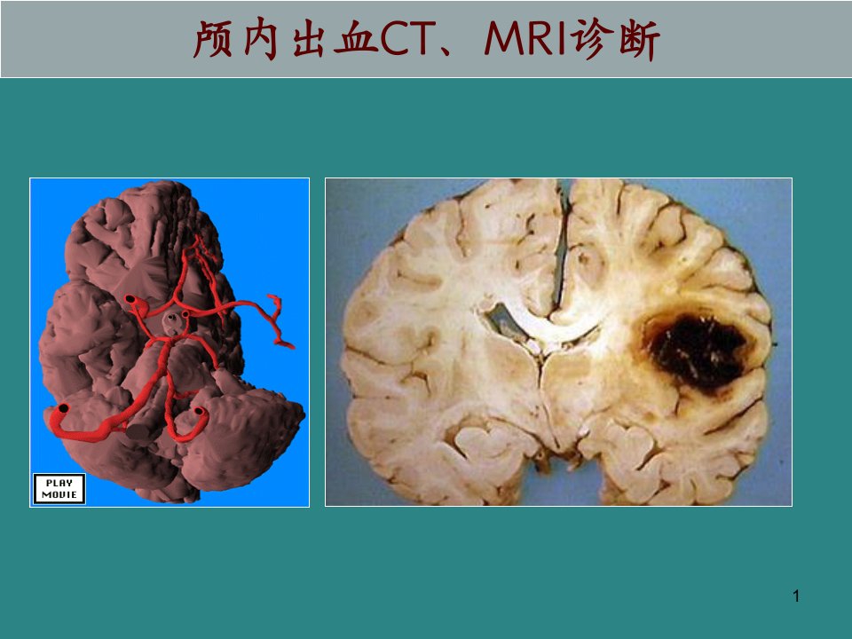 颅内出血CTMRI诊断ppt课件