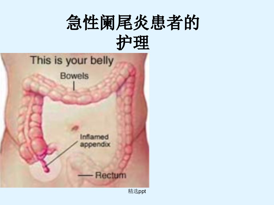 急性阑尾炎患者的护理