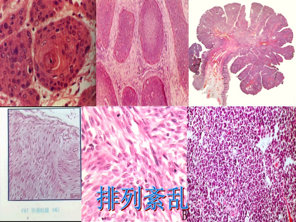 病理解剖学肿瘤二