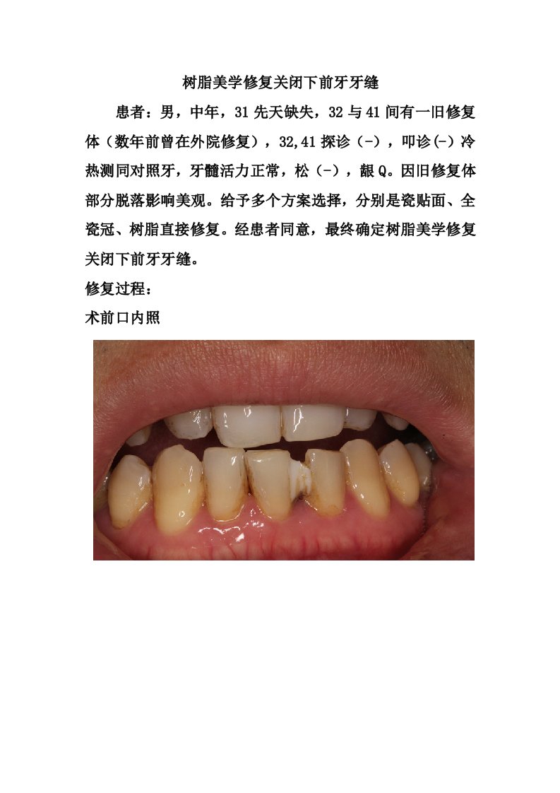 树脂美学修复关闭下前牙牙缝.doc