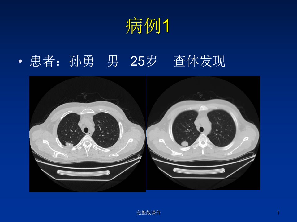 肺错构瘤影像表现PPT课件