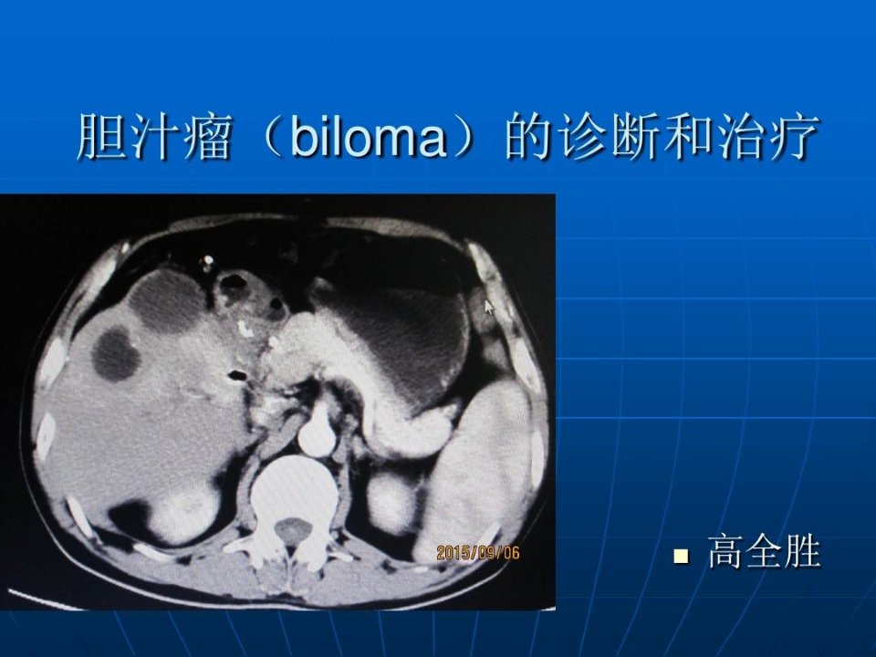 胆汁瘤(biloma)的诊断和治疗