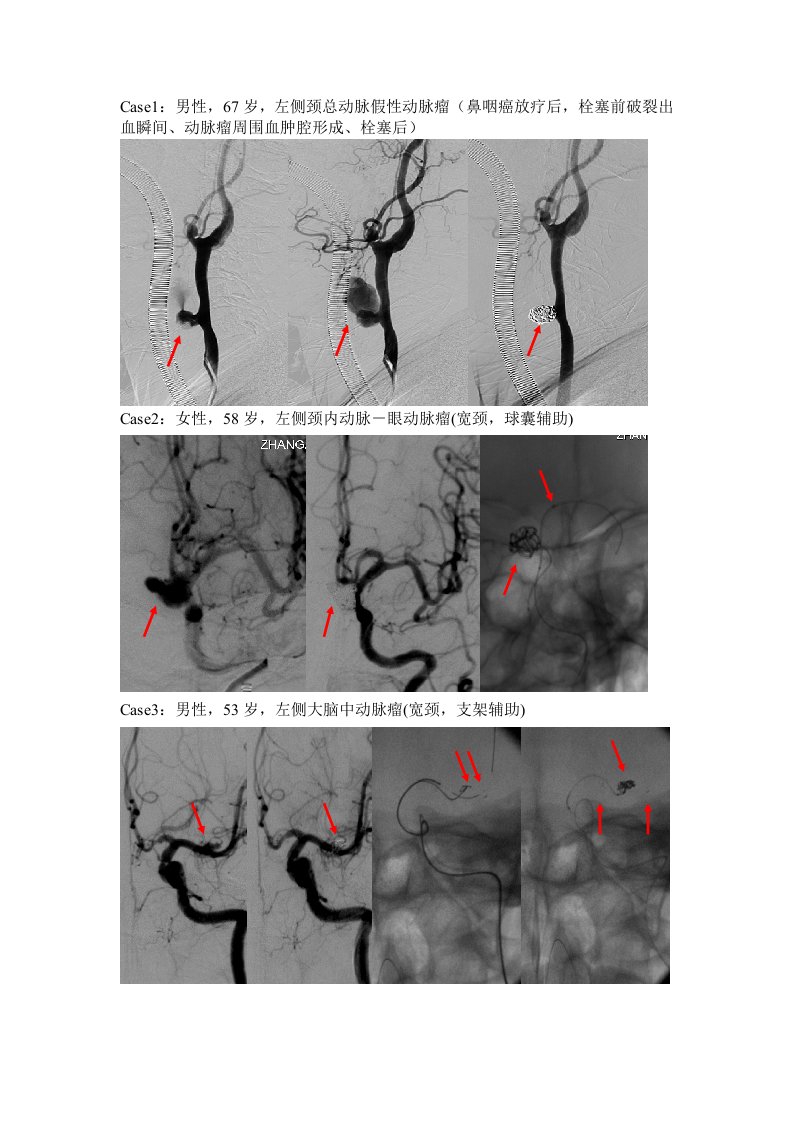 颅内动脉瘤典型病例