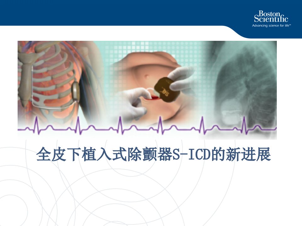 全皮下植入式除颤器sicd的新进展