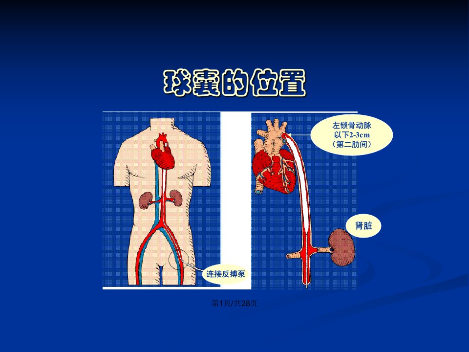 IABP的临床使用及护理强建新