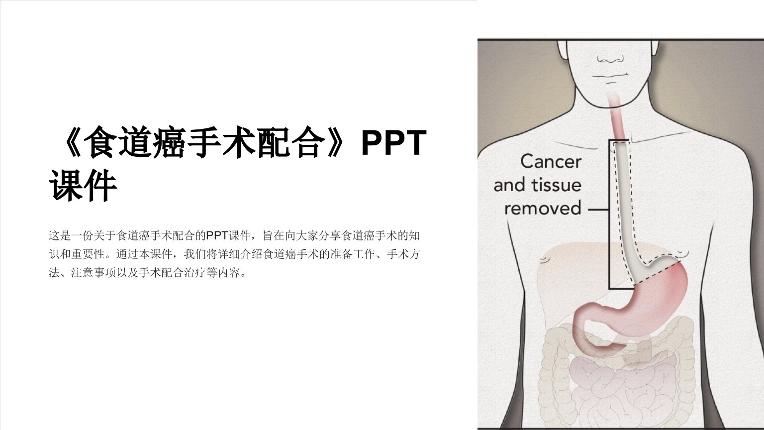 《食道癌手术配合》课件