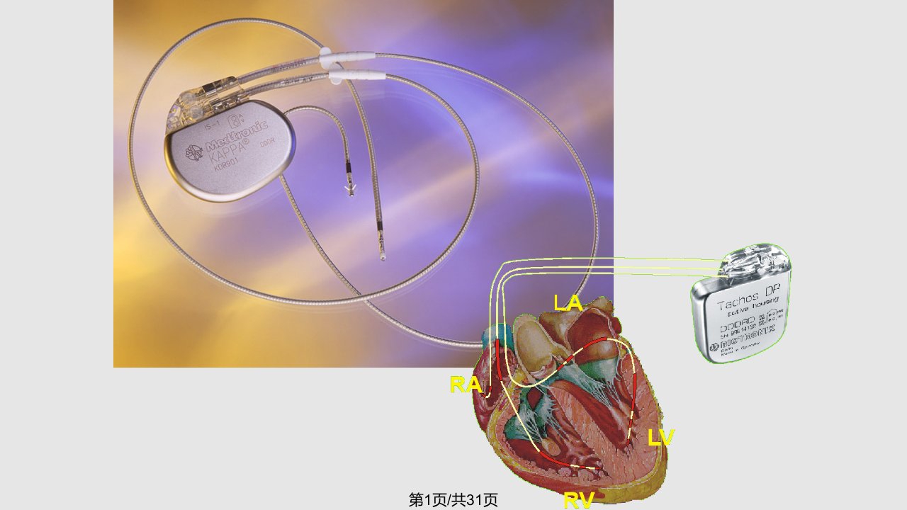心脏起搏器图文PPT课件