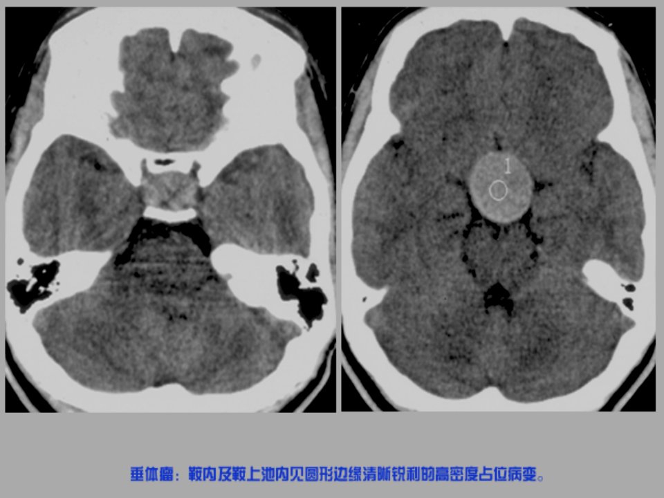 《脑部疾病诊断》PPT课件