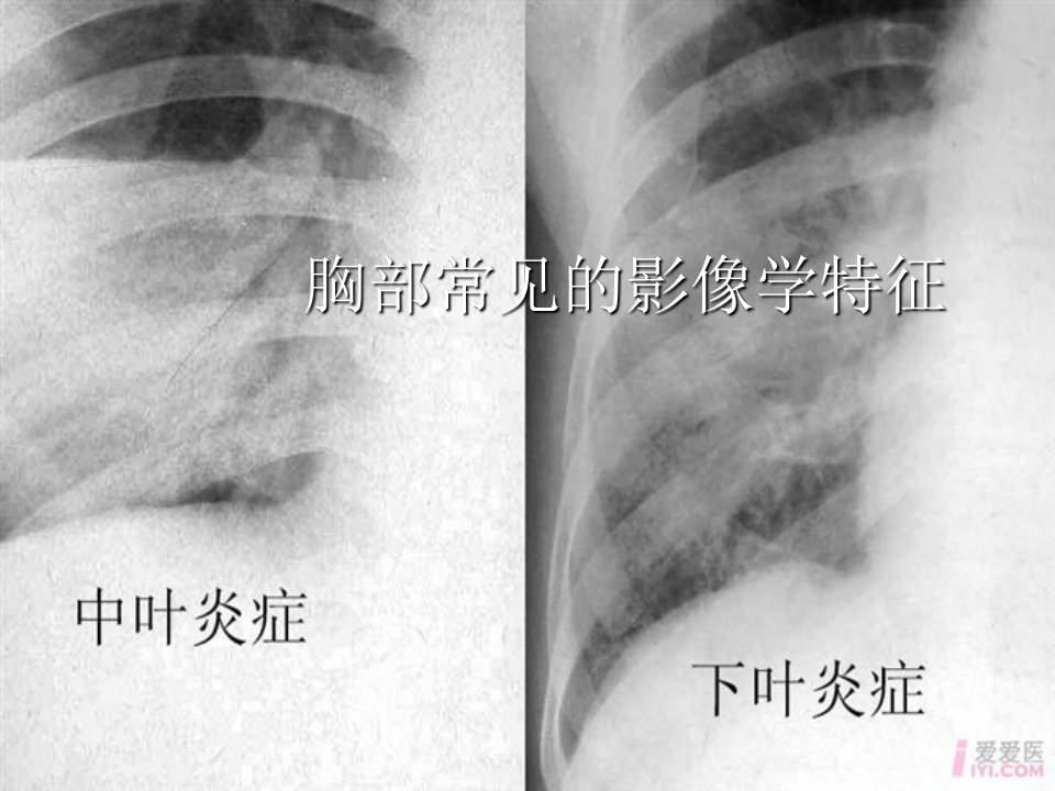 肺部影像学常见的特征