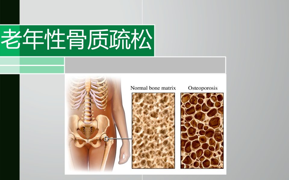 老性骨质疏松幻灯片