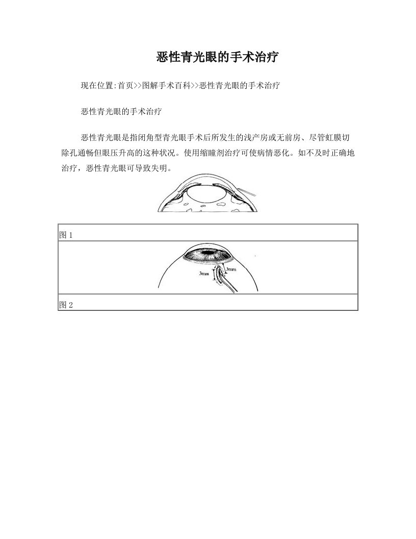 恶性表光眼手术治疗