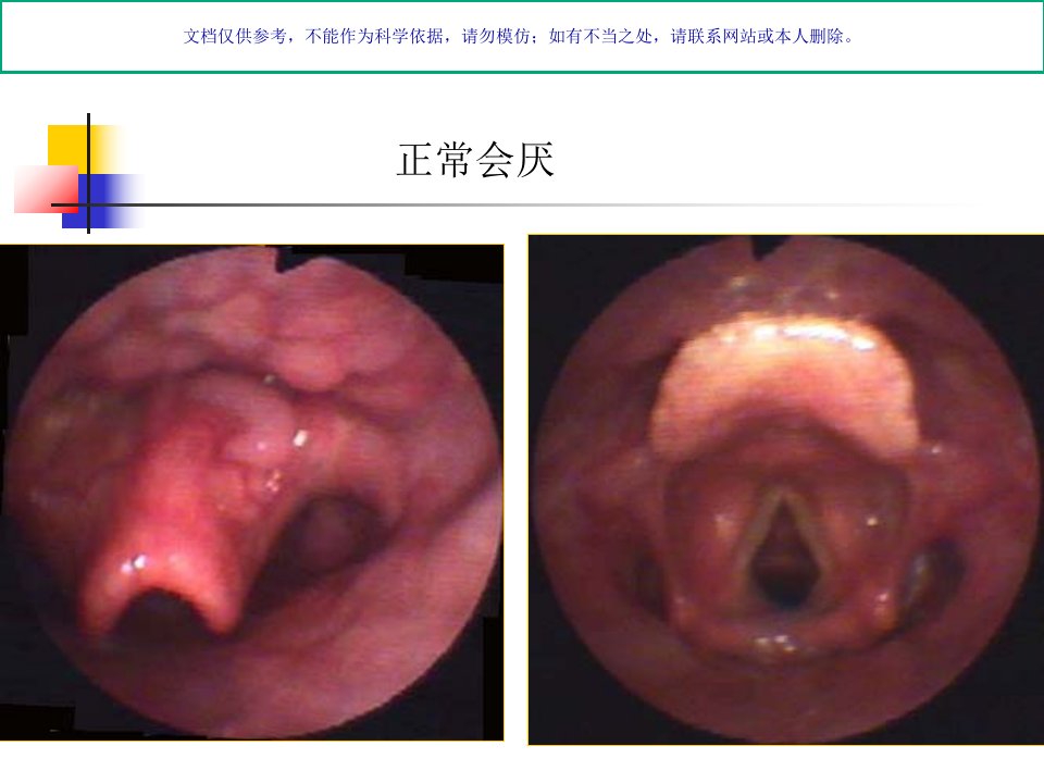 急性会厌炎专业医学知识宣讲课件