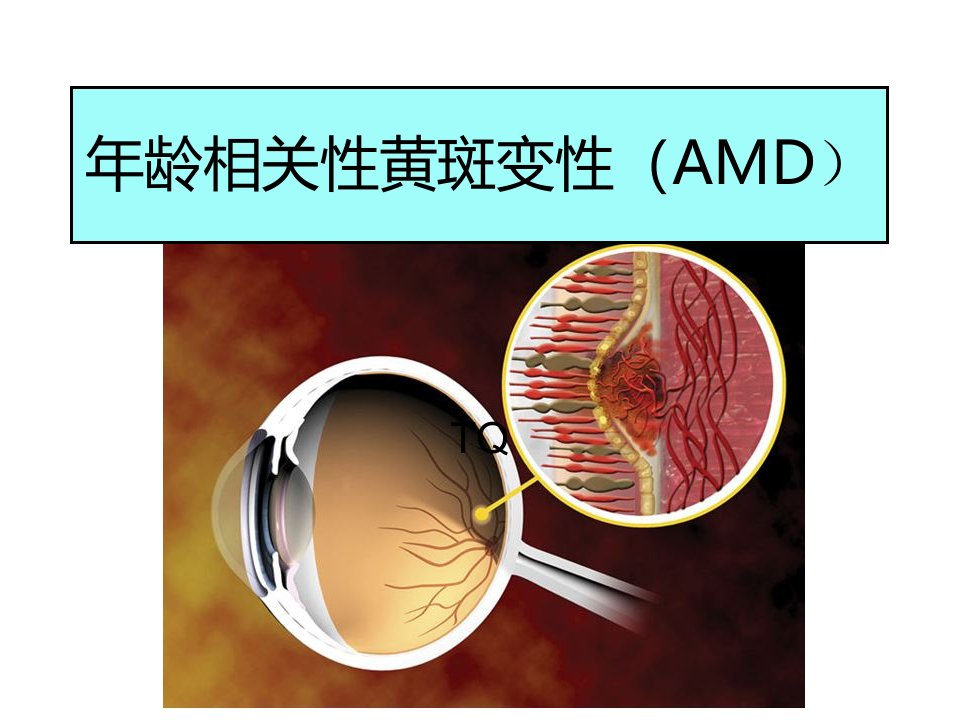 6、AMD-年龄相关性黄斑变性