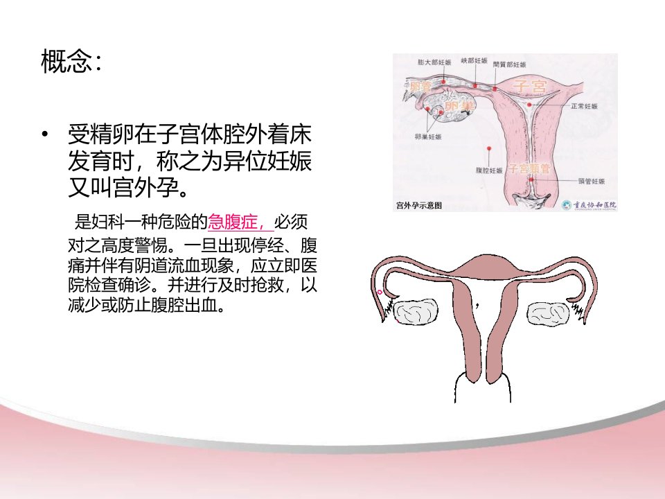 宫外孕腹腔镜术前术后的护理ppt课件