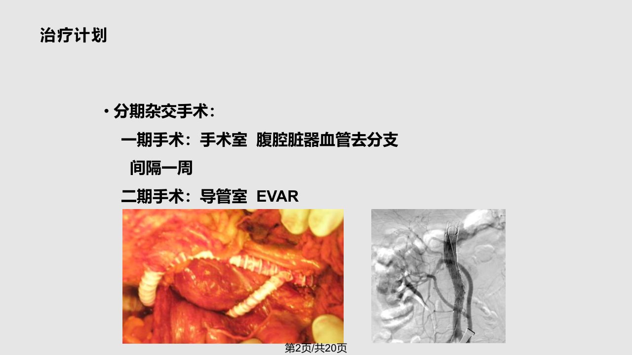 杂交手术治疗活动期炎性型胸腹主动脉瘤